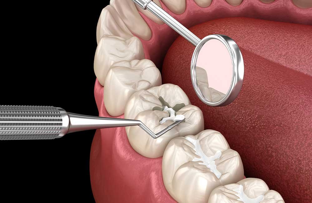 back teeth filling