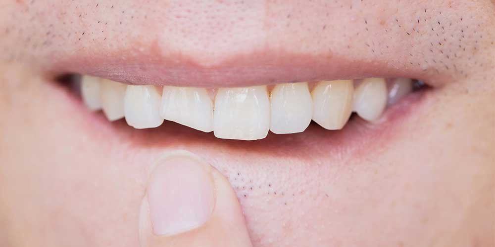 cracked tooth dental emmergency