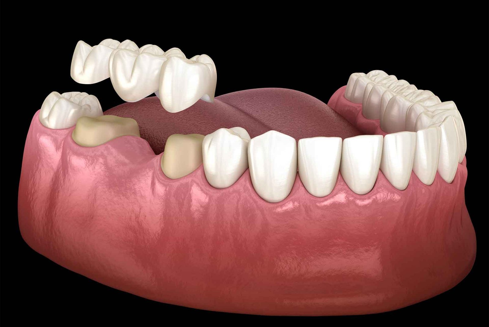 dental brdiges