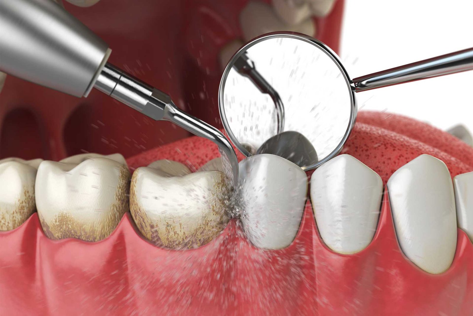 dental cleaning 3d