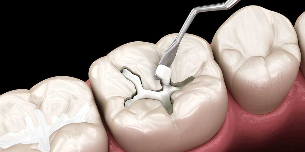 dental composite filling