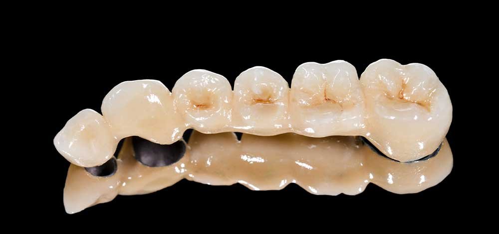 dental crown bridge