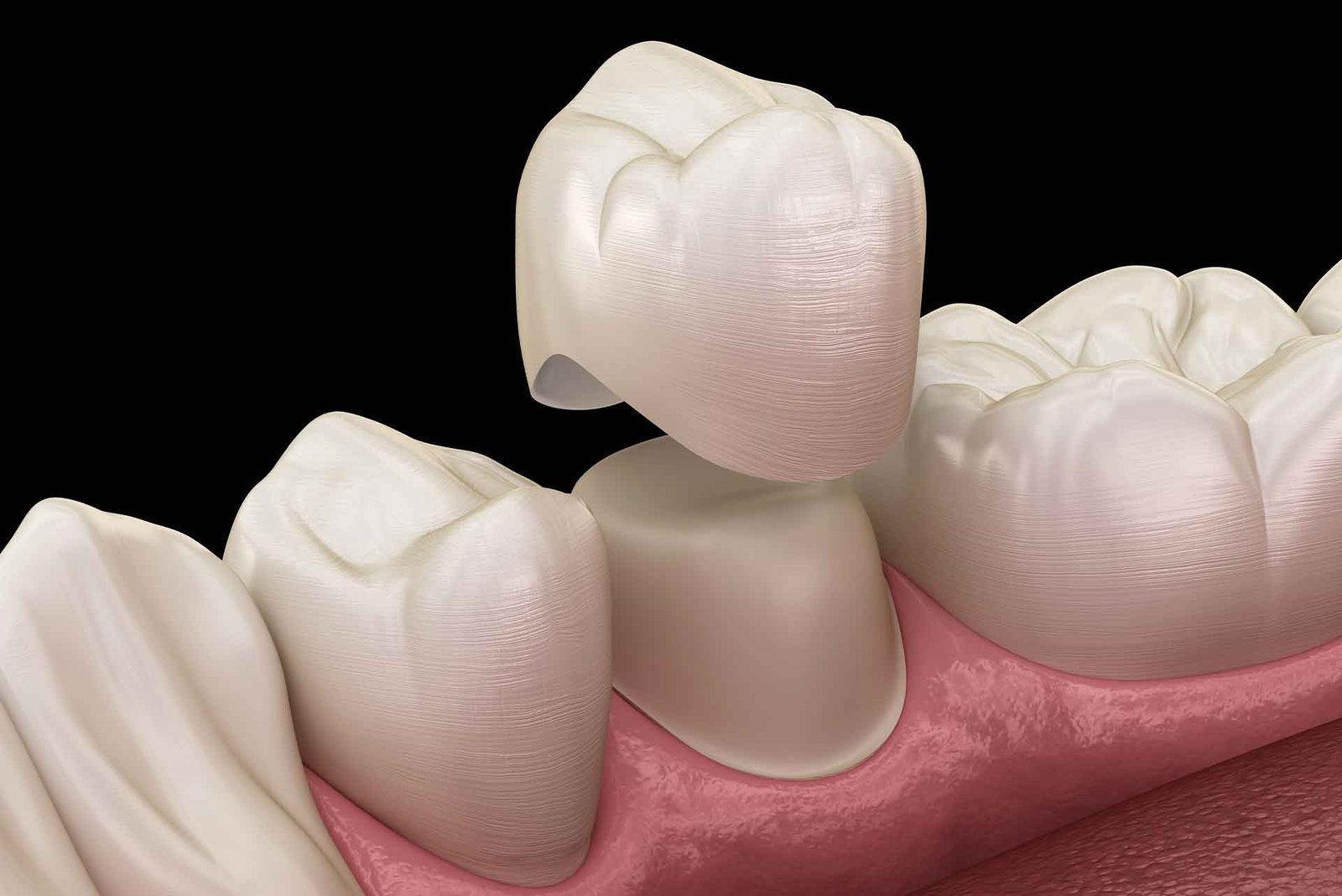 dental crowns view