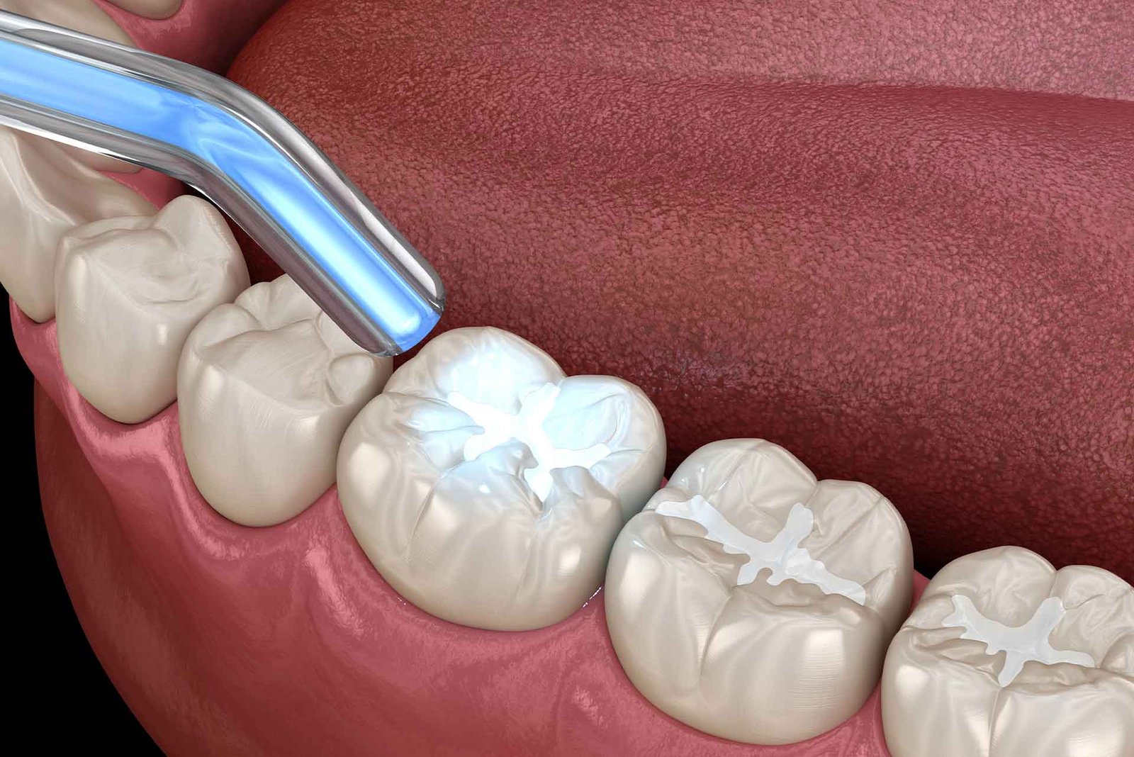 dental fillings