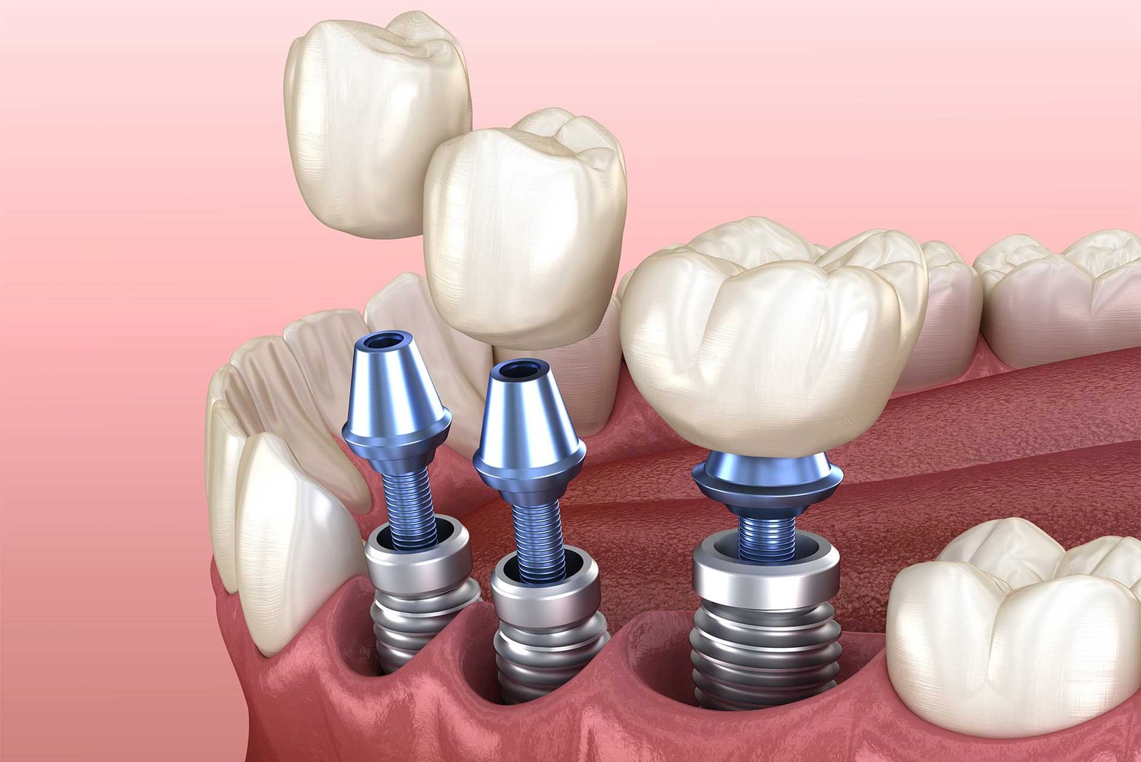 dental implant 3d view