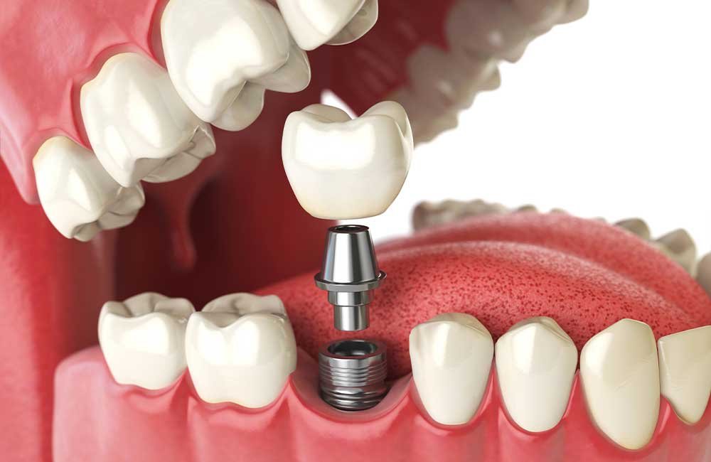 dental implant image
