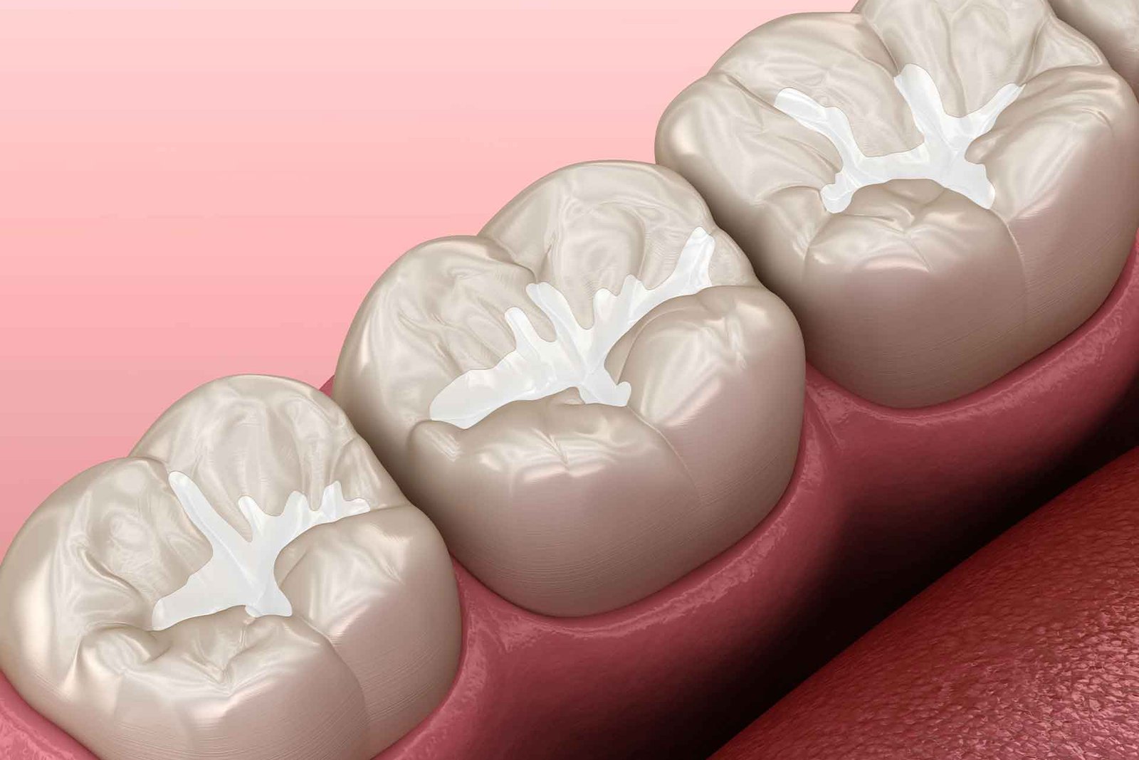 dental sealants view