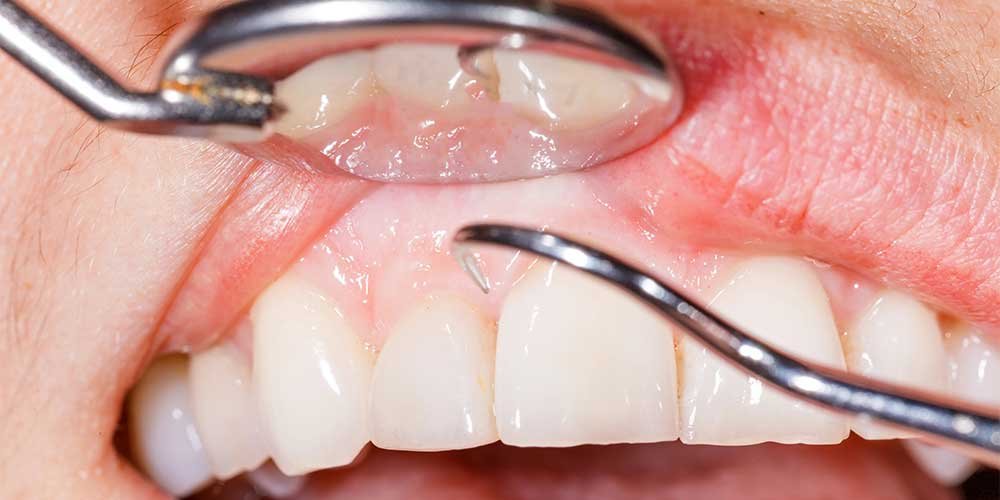 gum issues zoom