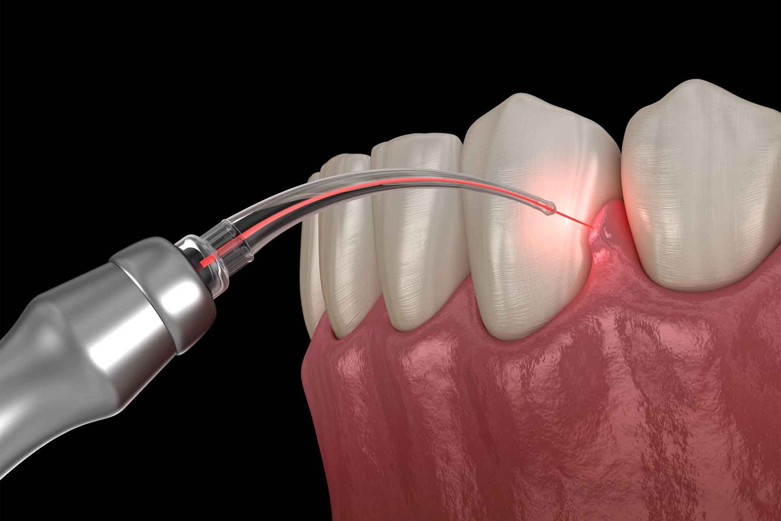 gum treatment