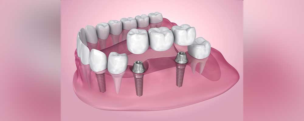 implant support brdige