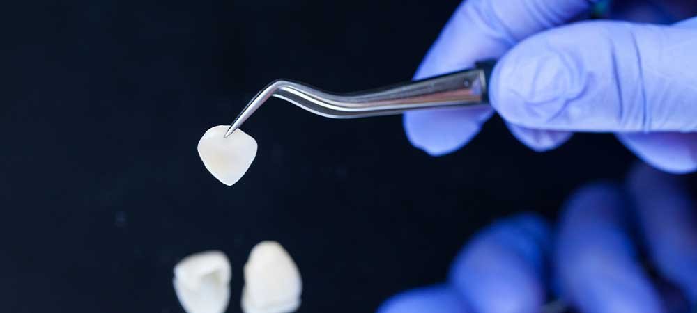 porcelian veneer with dentist