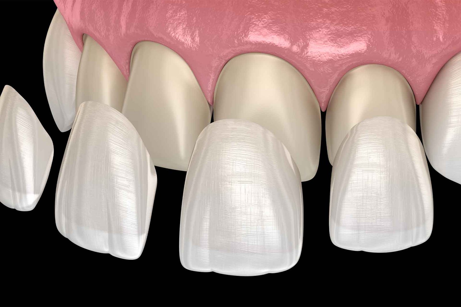 porcelian veneer