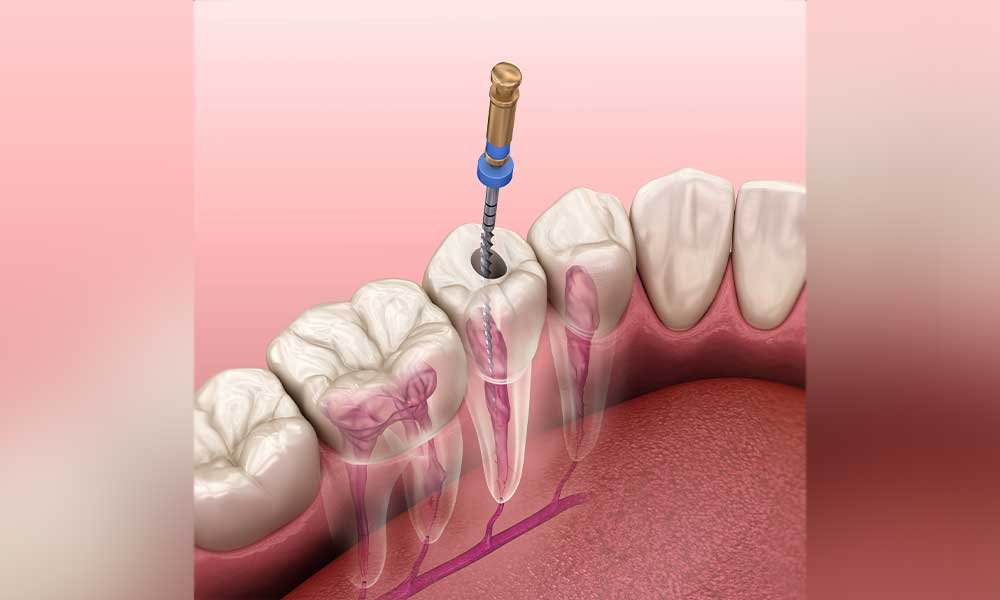 root canal therophy new
