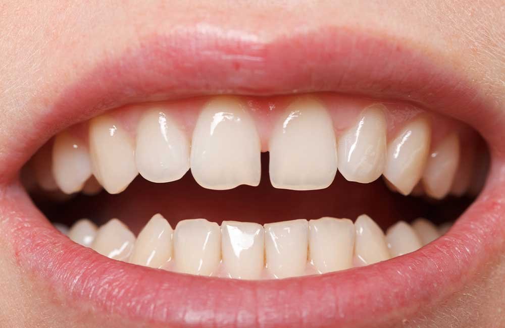 teeth gap