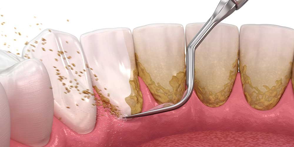 what is root plaining